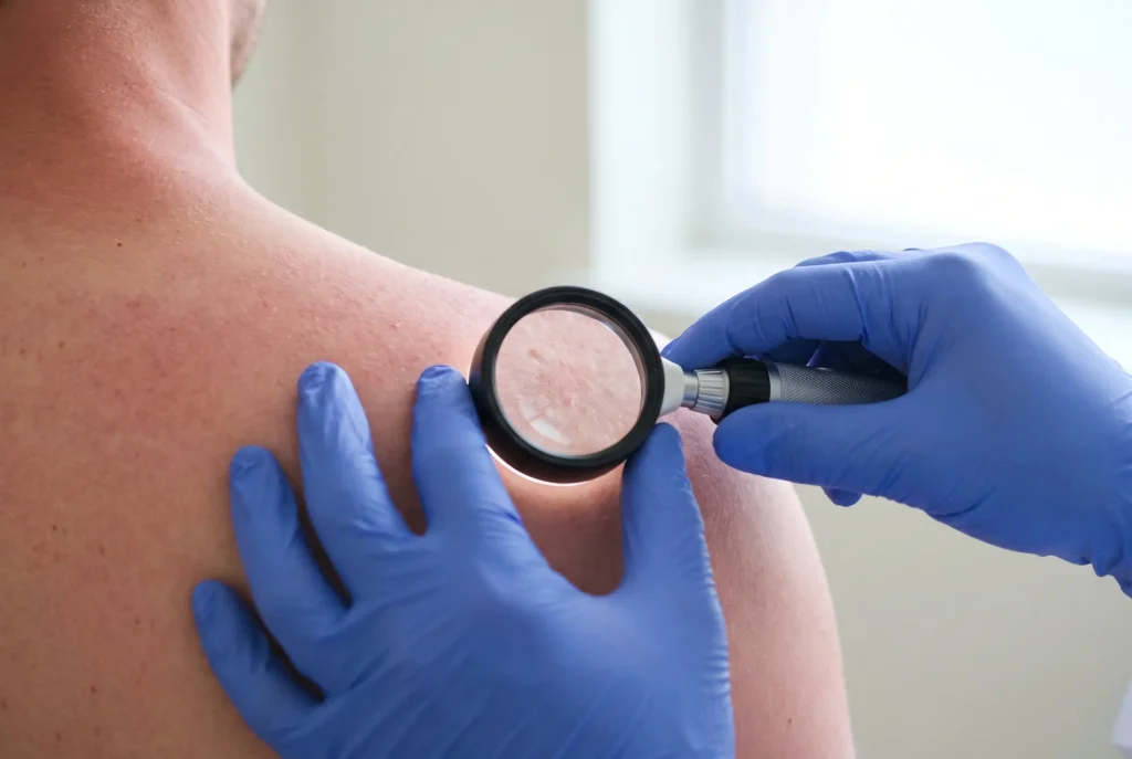 A dermatoscope being used to examine sun-irritated skin on a patient's shoulder at the Railay clinic